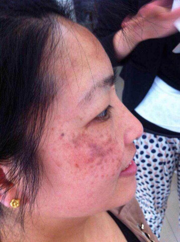 真皮斑植物提取液: 一次技术能干净70%-80%,最重真皮斑两次搞定.