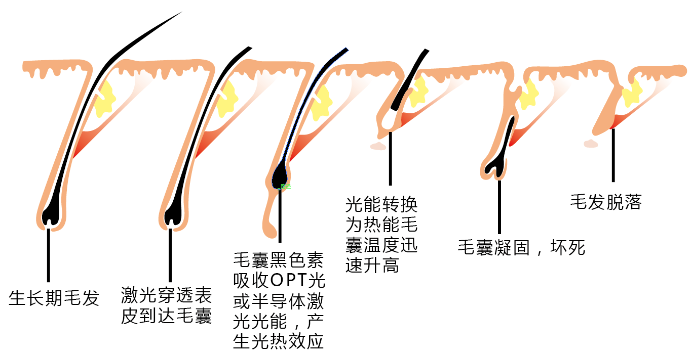 opt變電脫毛原理: 利用毛囊黑色素細胞和正常表皮對特定波長,特定能量