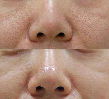 皮肤粗糙的原因主要是因为皮脂过度分泌导致毛孔粗大.